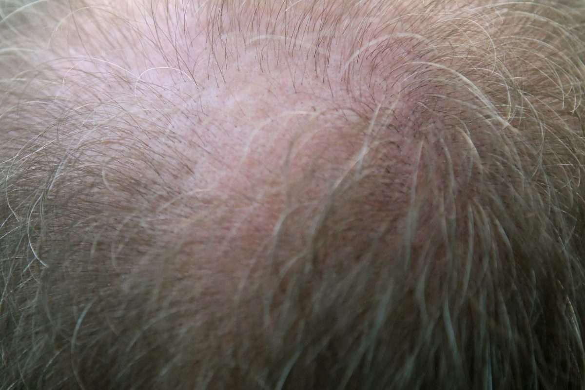 alopecia areata stress