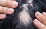 Alopecia areata, ok Aifa a rimborsabilità nuovo trattamento